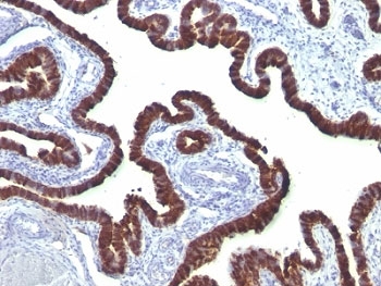 KRT7 / CK7 / Cytokeratin 7 Antibody - Formalin-fixed, paraffin-embedded ovarian carcinoma stained with Cytokeratin 7 antibody (OV-TL12/30).  This image was taken for the unmodified form of this product. Other forms have not been tested.