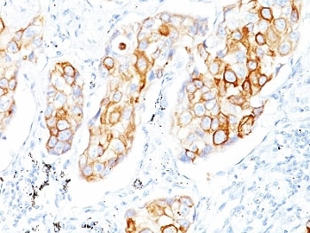 KRT7 / CK7 / Cytokeratin 7 Antibody - Formalin-fixed, paraffin-embedded human lung SCC stained with Cytokeratin 7 antibody (OV-TL12/30).  This image was taken for the unmodified form of this product. Other forms have not been tested.