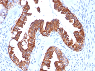 KRT7 / CK7 / Cytokeratin 7 Antibody - Formalin-fixed, paraffin-embedded human Endometrial Carcinoma stained with CK7 Recombinant Mouse Monoclonal Antibody (rOV-TL12/30).