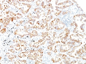 KRT7 / CK7 / Cytokeratin 7 Antibody - Formalin-fixed, paraffin-embedded human lung SCC stained with Keratin 7 antibody (SPM270).  This image was taken for the unmodified form of this product. Other forms have not been tested.