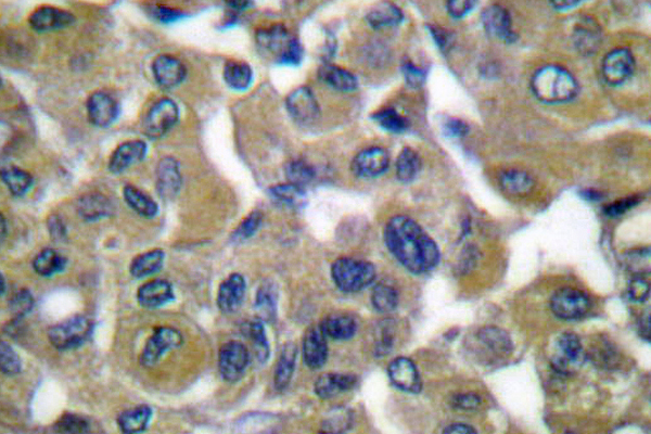 KRT7 / CK7 / Cytokeratin 7 Antibody - IHC of Cytokeratin 7 (L451) pAb in paraffin-embedded human breast carcinoma tissue.