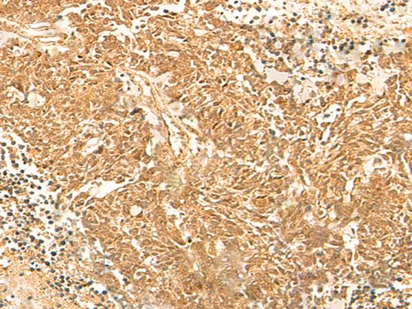 KRT76 / Keratin 76 Antibody - Immunohistochemistry of paraffin-embedded Human lung cancer tissue  using KRT76 Polyclonal Antibody at dilution of 1:30(×200)