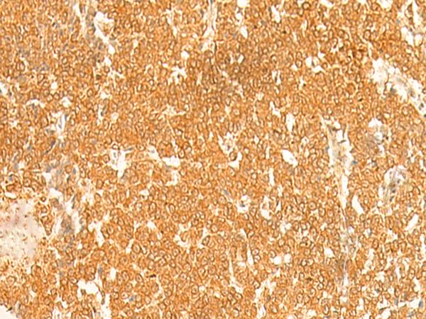 KRT76 / Keratin 76 Antibody - Immunohistochemistry of paraffin-embedded Human ovarian cancer tissue  using KRT76 Polyclonal Antibody at dilution of 1:30(×200)