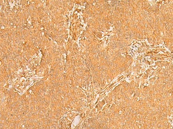 KRT76 / Keratin 76 Antibody - Immunohistochemistry of paraffin-embedded Human breast cancer tissue  using KRT76 Polyclonal Antibody at dilution of 1:50(×200)