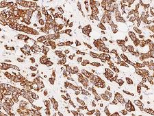 KRT76 / Keratin 76 Antibody - Immunochemical staining of human KRT76 in human breast carcinoma with rabbit polyclonal antibody at 1:1000 dilution, formalin-fixed paraffin embedded sections.