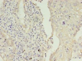 KRT8 / CK8 / Cytokeratin 8 Antibody - Immunohistochemistry of paraffin-embedded human lung cancer using antibody at 1:100 dilution.  This image was taken for the unconjugated form of this product. Other forms have not been tested.