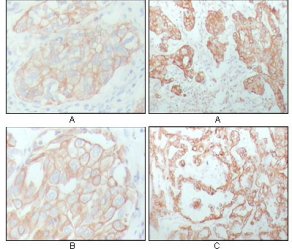 KRT8 / CK8 / Cytokeratin 8 Antibody - IHC of paraffin-embedded human breast carcinoma (A), lung cancer (B) and ovarian cancer tissue (C), showing membrane and cytoplasmic localization with DAB staining using CK8 mouse mAb.