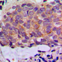 KRT8 / CK8 / Cytokeratin 8 Antibody - Immunohistochemical analysis of Cytokeratin 8 staining in human breast cancer formalin fixed paraffin embedded tissue section. The section was pre-treated using heat mediated antigen retrieval with sodium citrate buffer (pH 6.0). The section was then incubated with the antibody at room temperature and detected using an HRP conjugated compact polymer system. DAB was used as the chromogen. The section was then counterstained with hematoxylin and mounted with DPX.