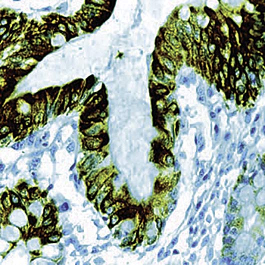 KRT8 / CK8 / Cytokeratin 8 Antibody - Formalin-fixed, paraffin-embedded human colon carcinoma stained with Cytokeratin 8 antibody.