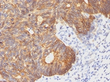 KRT8 / CK8 / Cytokeratin 8 Antibody - Formalin-fixed, paraffin-embedded human colon carcinoma stained with Cytokeratin 8 antibody (C-43).  This image was taken for the unmodified form of this product. Other forms have not been tested.