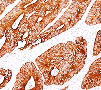 KRT8 / CK8 / Cytokeratin 8 Antibody - Cytokeratin 8 antibody K8/383 immunohistochemistry colon carcinoma.  This image was taken for the unmodified form of this product. Other forms have not been tested.