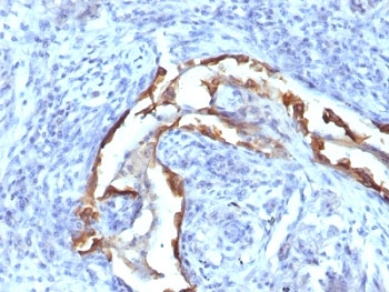 KRT8 / CK8 / Cytokeratin 8 Antibody - Formalin-fixed, paraffin-embedded human lung carcinoma stained with Cytokeratin 8 antibody (SPM538).  This image was taken for the unmodified form of this product. Other forms have not been tested.