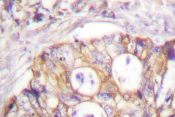 KRT8 / CK8 / Cytokeratin 8 Antibody - IHC of K8 (G427) pAb in paraffin-embedded human colon carcinoma tissue.