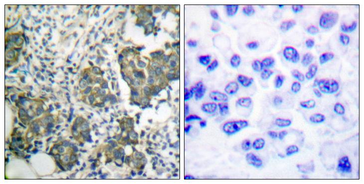 KRT8 / CK8 / Cytokeratin 8 Antibody - Peptide - + Immunohistochemical analysis of paraffin-embedded human breast carcinoma tissue using Keratin 8 (Ab-73) antibody.