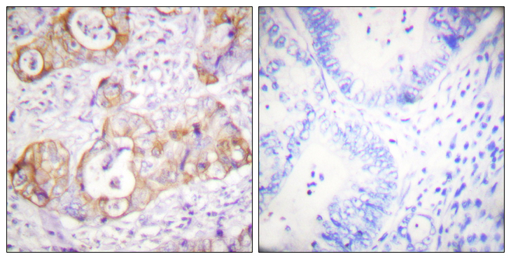 KRT8 / CK8 / Cytokeratin 8 Antibody - Immunohistochemistry analysis of paraffin-embedded human colon carcinoma, using Keratin 8 (Phospho-Ser432) Antibody. The picture on the right is blocked with the phospho peptide.