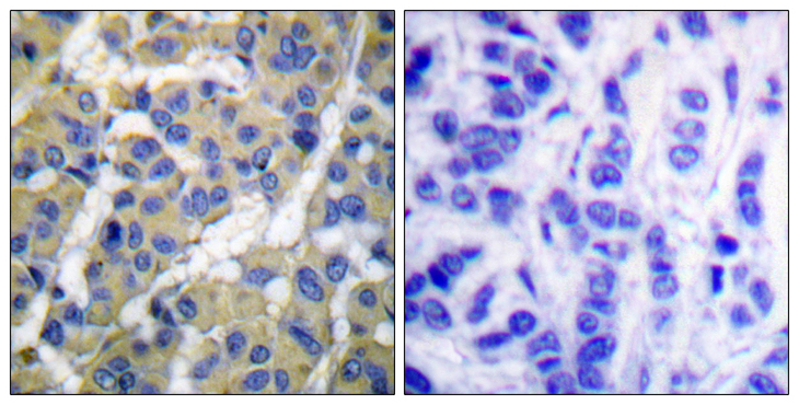 KRT8 / CK8 / Cytokeratin 8 Antibody - Immunohistochemistry analysis of paraffin-embedded human breast carcinoma, using Keratin 8 (Phospho-Ser73) Antibody. The picture on the right is blocked with the phospho peptide.