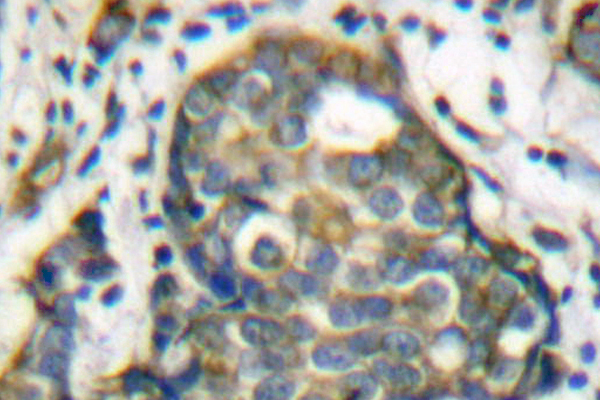 KRT8 / CK8 / Cytokeratin 8 Antibody - IHC of Cytokeratin 8 (V67) pAb in paraffin-embedded human breast carcinoma tissue.