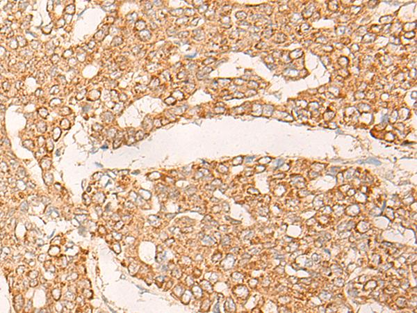 KRT9 / CK9 / Cytokeratin 9 Antibody - Immunohistochemistry of paraffin-embedded Human liver cancer tissue  using KRT9 Polyclonal Antibody at dilution of 1:30(×200)