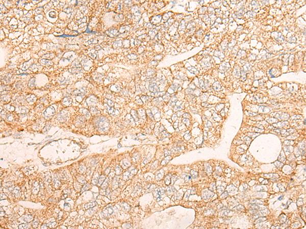 KRT9 / CK9 / Cytokeratin 9 Antibody - Immunohistochemistry of paraffin-embedded Human gastric cancer tissue  using KRT9 Polyclonal Antibody at dilution of 1:30(×200)