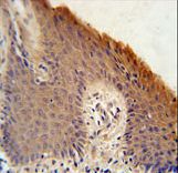 KRTAP1-1 Antibody - KRTAP1-1 Antibody immunohistochemistry of formalin-fixed and paraffin-embedded human skin carcinoma followed by peroxidase-conjugated secondary antibody and DAB staining.
