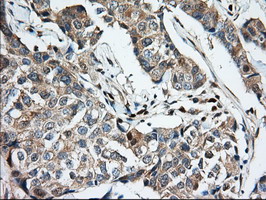 KSP32 / MIOX Antibody - IHC of paraffin-embedded Adenocarcinoma of Human breast tissue using anti-MIOX mouse monoclonal antibody.