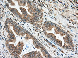 KSP32 / MIOX Antibody - IHC of paraffin-embedded Adenocarcinoma of Human colon tissue using anti-MIOX mouse monoclonal antibody.