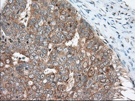 KSP32 / MIOX Antibody - IHC of paraffin-embedded Adenocarcinoma of Human ovary tissue using anti-MIOX mouse monoclonal antibody.
