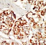 KSR1 Antibody - Formalin-fixed and paraffin-embedded human cancer tissue reacted with the primary antibody, which was peroxidase-conjugated to the secondary antibody, followed by DAB staining. This data demonstrates the use of this antibody for immunohistochemistry; clinical relevance has not been evaluated. BC = breast carcinoma; HC = hepatocarcinoma.