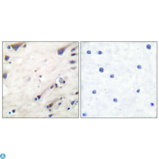KSR1 Antibody - Immunohistochemical analysis of paraffin-embedded Human breast cancer. Antibody was diluted at 1:100 (4°C, overnight). High-pressure and temperature Tris-EDTA, pH8.0 was used for antibody retrieval. Negative control (right) obtained from antibody was pre-absorbed by immunogen peptide.