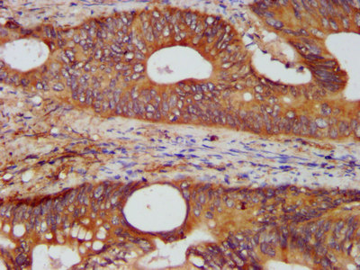 KTN1 / Kinectin Antibody - Immunohistochemistry image at a dilution of 1:400 and staining in paraffin-embedded human colon cancer performed on a Leica BondTM system. After dewaxing and hydration, antigen retrieval was mediated by high pressure in a citrate buffer (pH 6.0) . Section was blocked with 10% normal goat serum 30min at RT. Then primary antibody (1% BSA) was incubated at 4 °C overnight. The primary is detected by a biotinylated secondary antibody and visualized using an HRP conjugated SP system.