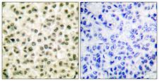 Ku70+Ku80 / XRCC6+XRCC5 Antibody - Peptide - + Immunohistochemical analysis of paraffin-embedded human breast carcinoma tissue using Ku70/80 antibody.