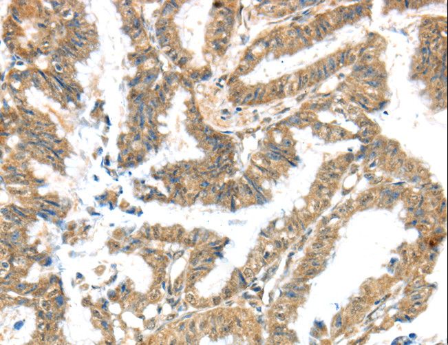 Kv10.1 / KCNG3 Antibody - Immunohistochemistry of paraffin-embedded Human liver cancer using KCNG3 Polyclonal Antibody at dilution of 1:40.
