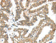 Kv10.1 / KCNG3 Antibody - Immunohistochemistry of paraffin-embedded Human liver cancer using KCNG3 Polyclonal Antibody at dilution of 1:40.