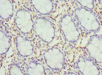Kv10.1 / KCNH1 Antibody - Immunohistochemistry of paraffin-embedded human colon cancer at dilution 1:100