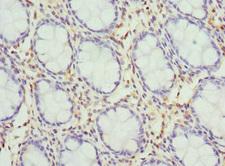 Kv10.1 / KCNH1 Antibody - Immunohistochemistry of paraffin-embedded human colon cancer at dilution 1:100