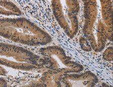 KV6.4 / KCNG4 Antibody - Immunohistochemistry of paraffin-embedded Human colon cancer using KCNG4 Polyclonal Antibody at dilution of 1:40.