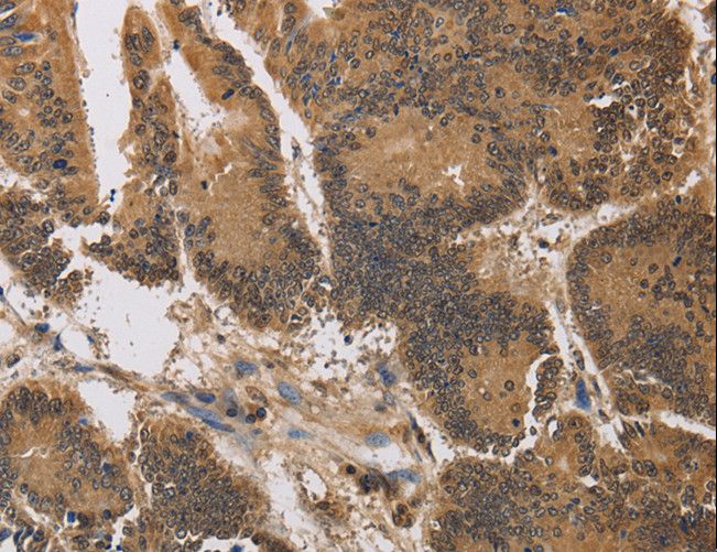 KV6.4 / KCNG4 Antibody - Immunohistochemistry of paraffin-embedded Human colon cancer using KCNG4 Polyclonal Antibody at dilution of 1:40.