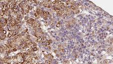 KV6.4 / KCNG4 Antibody - 1:100 staining human liver carcinoma tissues by IHC-P. The sample was formaldehyde fixed and a heat mediated antigen retrieval step in citrate buffer was performed. The sample was then blocked and incubated with the antibody for 1.5 hours at 22°C. An HRP conjugated goat anti-rabbit antibody was used as the secondary.