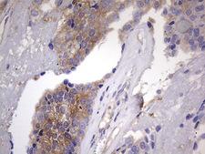 KYNU Antibody - IHC of paraffin-embedded Adenocarcinoma of Human breast tissue using anti-KYNU mouse monoclonal antibody. (heat-induced epitope retrieval by 1 mM EDTA in 10mM Tris, pH8.5, 120°C for 3min).