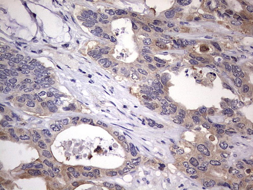 KYNU Antibody - IHC of paraffin-embedded Adenocarcinoma of Human colon tissue using anti-KYNU mouse monoclonal antibody. (heat-induced epitope retrieval by 1 mM EDTA in 10mM Tris, pH8.5, 120°C for 3min).