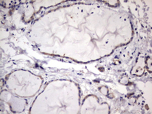 KYNU Antibody - IHC of paraffin-embedded Human thyroid tissue using anti-KYNU mouse monoclonal antibody. (heat-induced epitope retrieval by 1 mM EDTA in 10mM Tris, pH8.5, 120°C for 3min).