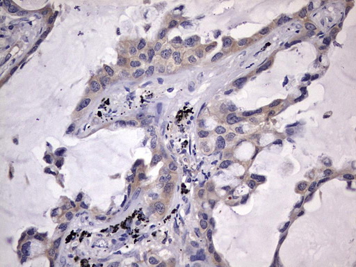 KYNU Antibody - IHC of paraffin-embedded Carcinoma of Human lung tissue using anti-KYNU mouse monoclonal antibody. (heat-induced epitope retrieval by 1 mM EDTA in 10mM Tris, pH8.5, 120°C for 3min).