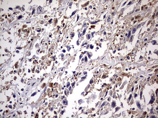KYNU Antibody - IHC of paraffin-embedded Adenocarcinoma of Human ovary tissue using anti-KYNU mouse monoclonal antibody. (heat-induced epitope retrieval by 1 mM EDTA in 10mM Tris, pH8.5, 120°C for 3min).