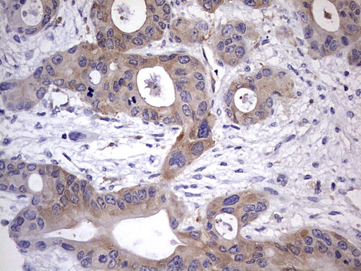 KYNU Antibody - IHC of paraffin-embedded Carcinoma of Human pancreas tissue using anti-KYNU mouse monoclonal antibody. (heat-induced epitope retrieval by 1 mM EDTA in 10mM Tris, pH8.5, 120°C for 3min).