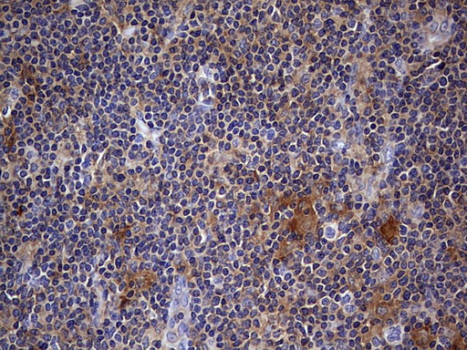 KYNU Antibody - IHC of paraffin-embedded Human lymphoma tissue using anti-KYNU mouse monoclonal antibody. (heat-induced epitope retrieval by 1 mM EDTA in 10mM Tris, pH8.5, 120°C for 3min).