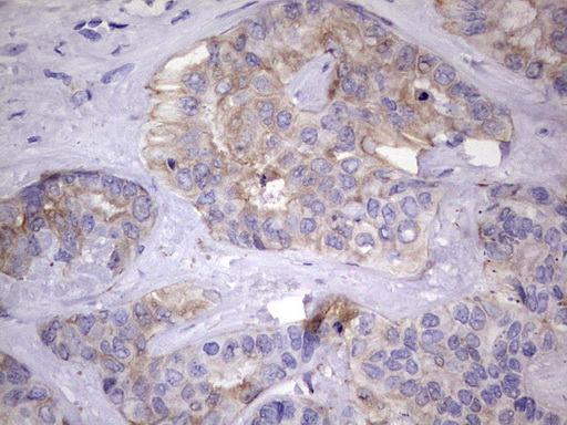 KYNU Antibody - IHC of paraffin-embedded Carcinoma of Human liver tissue using anti-KYNU mouse monoclonal antibody. (Heat-induced epitope retrieval by 1 mM EDTA in 10mM Tris, pH8.5, 120°C for 3min).