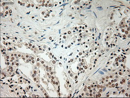 L1CAM Antibody - IHC of paraffin-embedded Carcinoma of prostate tissue using anti-L1CAM mouse monoclonal antibody. (Dilution 1:50).