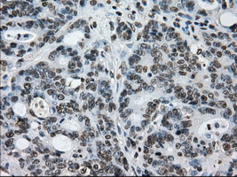 L1CAM Antibody - IHC of paraffin-embedded Adenocarcinoma of colon tissue using anti-L1CAMmouse monoclonal antibody. (Dilution 1:50).