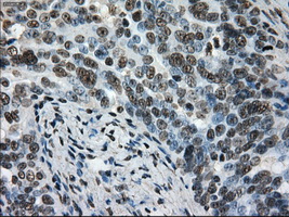 L1CAM Antibody - IHC of paraffin-embedded Adenocarcinoma of ovary tissue using anti-L1CAMmouse monoclonal antibody. (Dilution 1:50).