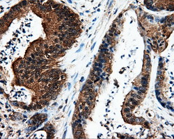 L1CAM Antibody - IHC of paraffin-embedded Adenocarcinoma of colon tissue using anti-L1CAM mouse monoclonal antibody. (Dilution 1:50).